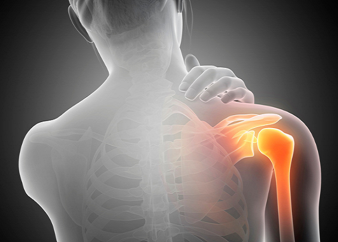 Frozen Shoulder