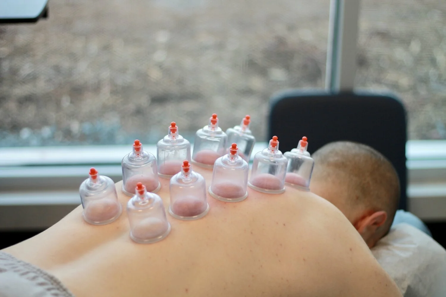 Capping therapy